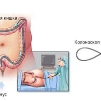 О колоноскопии: всё, что нужно знать о диагностике и профилактике