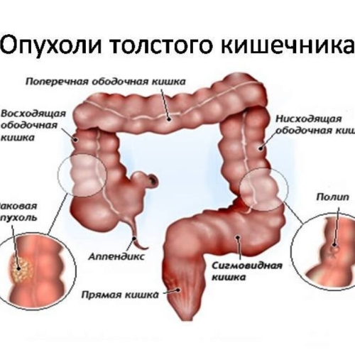 Рак толстой кишки: скрытая угроза, симптомы, факторы риска и меры защиты