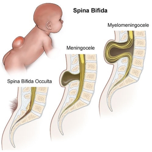 Spina bifida: расщепление позвоночника — что это, как диагностируется и лечится