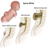 Spina bifida: расщепление позвоночника — что это, как диагностируется и лечится